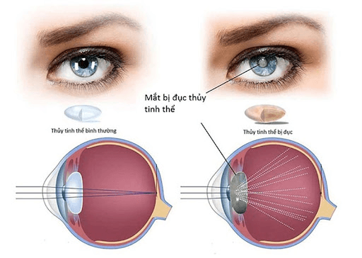 Nhận biết, phòng tránh và cách điều trị các bệnh về mắt gây mù lòa