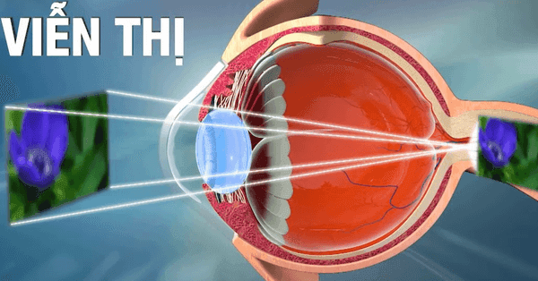 Viễn thị bẩm sinh là gì? Có cách chữa viễn thị bẩm sinh ở trẻ em không?