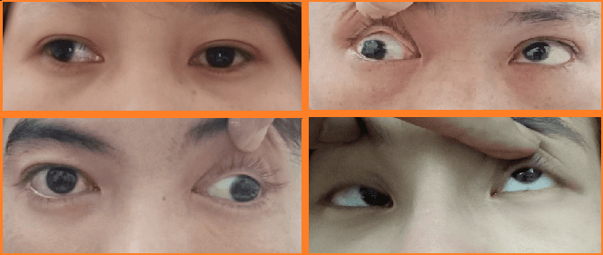 Mắt lác mô tả tình trạng khi nhìn hai mắt không cùng hướng về một điểm trong cùng một thời điểm