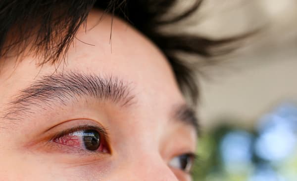 Vì sao đeo lens bị đỏ mắt?