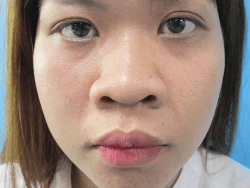 Mũi tẹt hay còn gọi là mũi thấp là dáng mũi có sống mũi thấp, hõm sâu xuống dưới