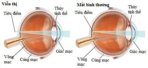 Viễn thị là một loại tật khúc xạ khi điểm ảnh hội tụ phía sau võng mạc