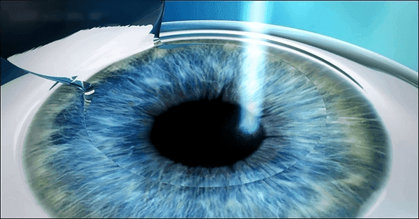 Phẫu thuật LASIK không gây đau đớn