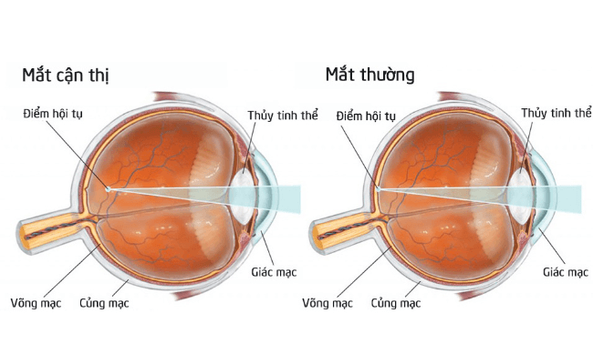 Cận thị hạn chế tầm nhìn xa