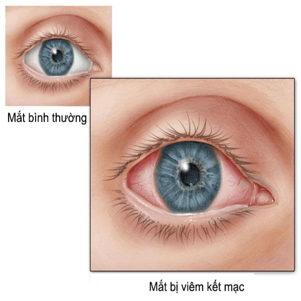 Viêm kết mạc nên được điều trị sớm nhất có thể