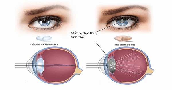 Bệnh đục thuỷ tinh thể đa số đều do lão hoá tự nhiên