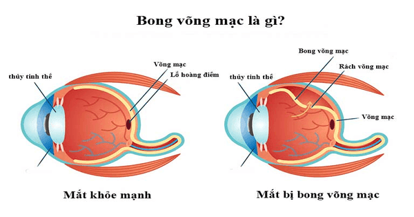 Bong võng mạc thường xuất hiện ở người cao tuổi