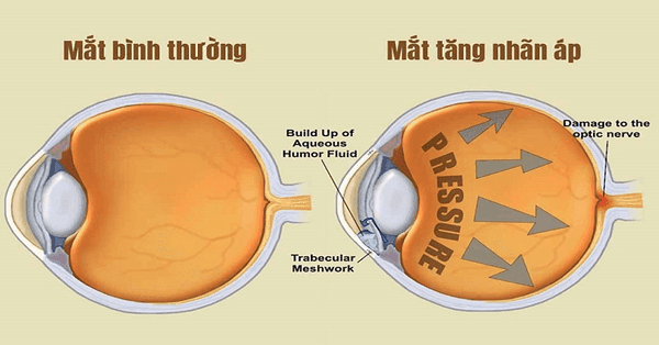Xuất huyết thể thuỷ tinh là khi máu chảy trong thuỷ tinh thể