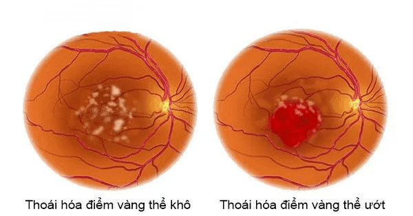 Bệnh thoái hoá điểm vàng là do tuổi già