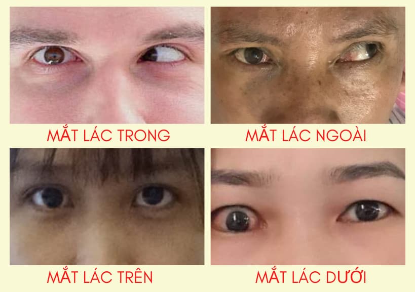 Phân loại mắt lác theo hướng lệch
