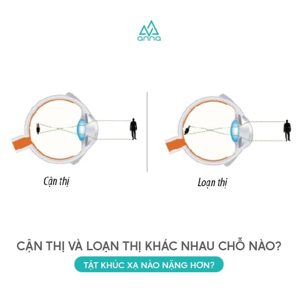 Cận Thị Và Loạn Thị Khác Nhau Chỗ Nào? Tật Khúc Xạ Nào Nặng Hơn?